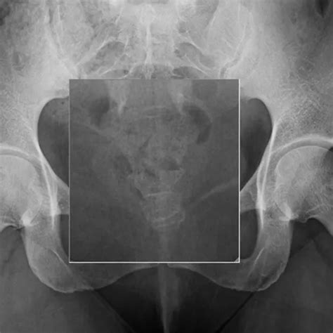 X-ray Sacrum-Coccyx LAT View | Test Price in Delhi | Ganesh Diagnostic