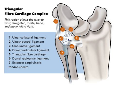 Guide to TFCC tears and sprains - TFCC Tears and Sprains