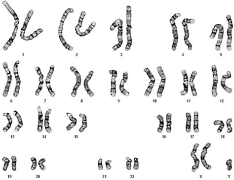 A Karyotype Of 47xx21 Download Scientific Diagram