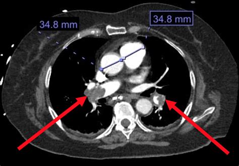 Cureus | Massive Pulmonary Embolism in a Recent Intracranial Hemorrhage: A Case Report of ...