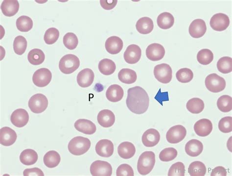 What is the difference between polychromatophilic red cell and a reticulocyte? • The Blood Project