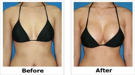 Pin on Breast Augmentation