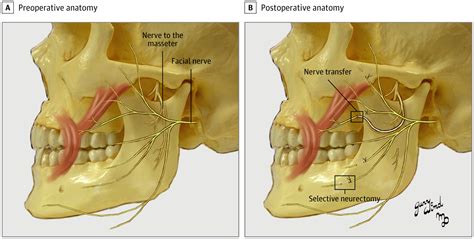 Masseteric-to-Facial Nerve Transfer and Selective Neurectomy for ...