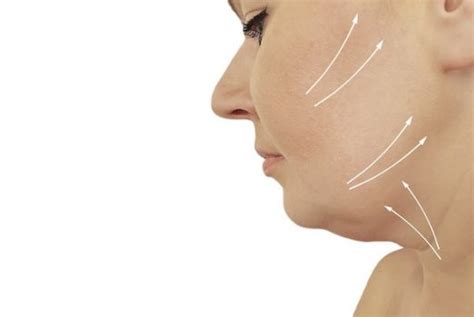 Chin Lift - Natural and Pain Free - Contouring and Double Chin Removal