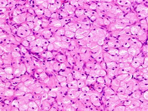 Congenital epulis | BMJ Case Reports