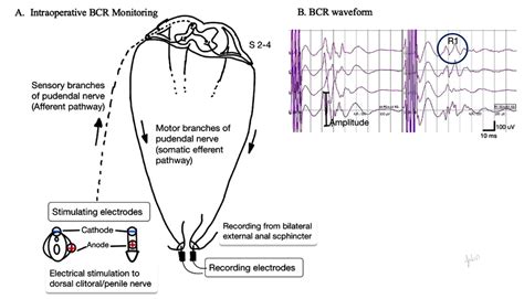 A. Intraoperative bulbocavernosus reflex (BCR) monitoring. B. BCR... | Download Scientific Diagram