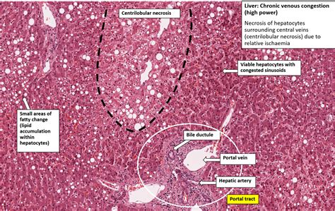 Liver – Chronic Venous Congestion – NUS Pathweb :: NUS Pathweb