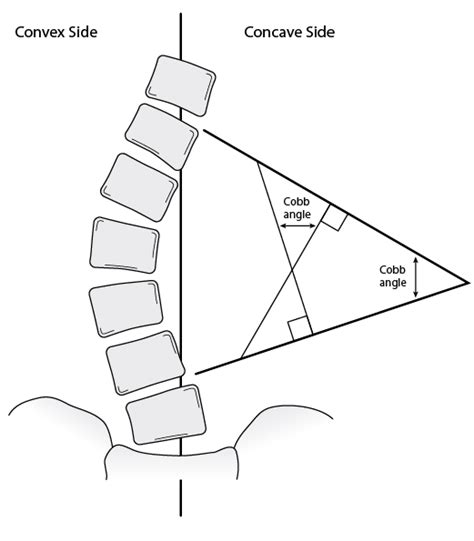 Figure: The Cobb Angle - MSD Manual Consumer Version