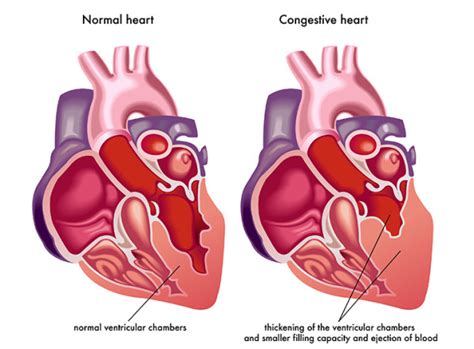 What is Congestive Heart Failure? - University Health News