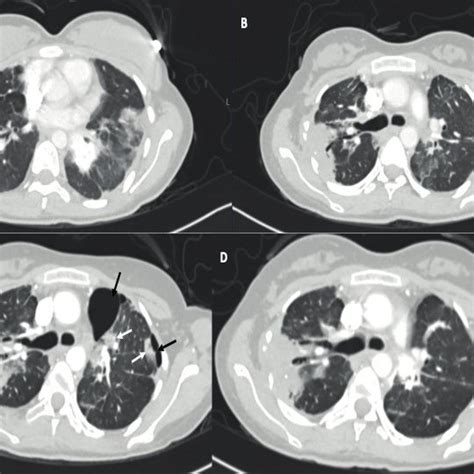 Thorax CT images of the second case. (A) First pneumothorax developing... | Download Scientific ...