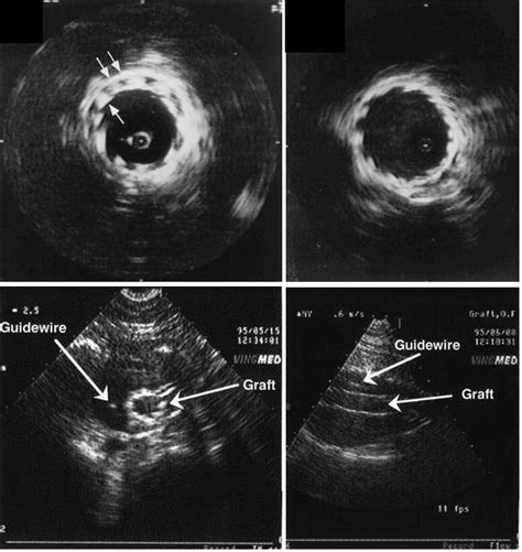 Ultrasound in Abdominal Aortic Aneurysm | IntechOpen