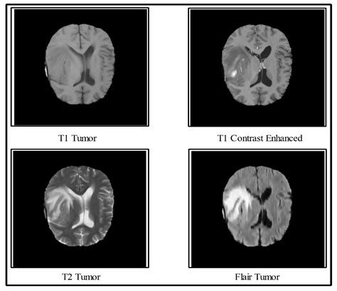 Brain Tumor Color Mri