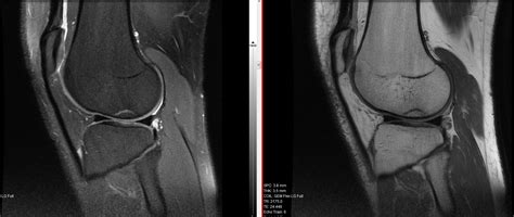 Knee - Stress Fracture - Home