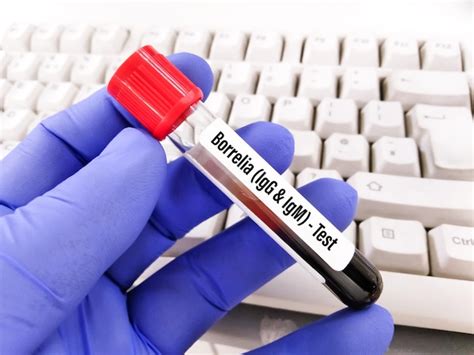 Premium Photo | Blood sample tube for borrelia igg and igm test, lyme ...