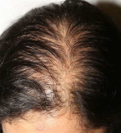 Thyroid And Hair Loss | Galhairs