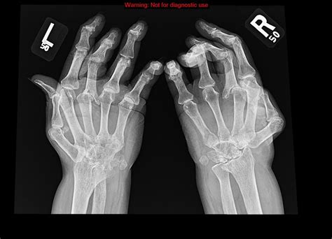 Rheumatoid Arthritis Hand X Ray