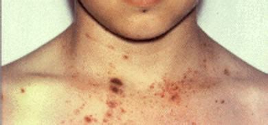 Sepsis Rash