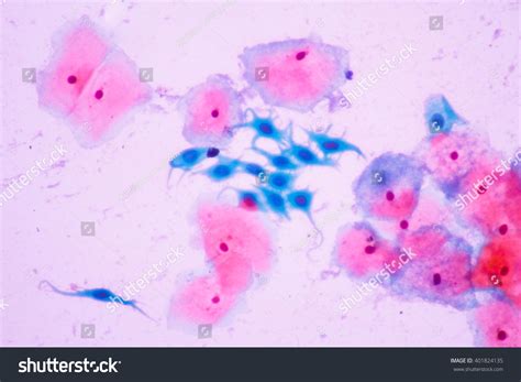 What Are Squamous Metaplastic Cells On A Pap