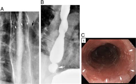 Elevated Z line: a new sign of Barrett’s esophagus on double-contrast ...