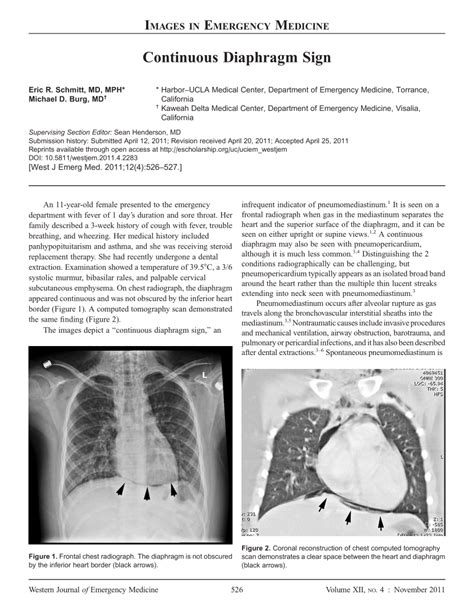 (PDF) Continuous Diaphragm Sign