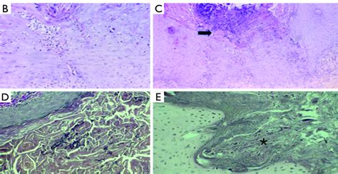 Reactive perforating collagenosis histology: central crateriform area... | Download Scientific ...