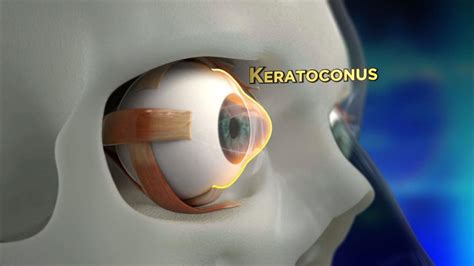 Keratoconus Procedure Explained - YouTube