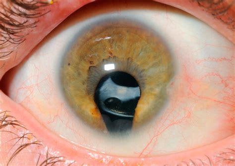 Iris Coloboma with intra-ocular lens. | Wellcome Collection