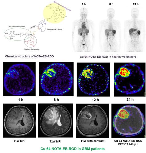 New PET radiotracer proven safe and effective in imaging malignant brain tumors