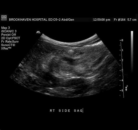 Intussusception ultrasound - wikidoc