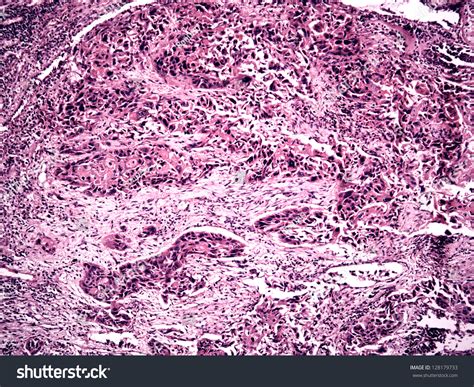 Central Lung Cancer Of A Human, Photomicrograph Panorama As Seen Under The Microscope, 100x Zoom ...