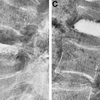 Four types of bone cement distribution: (A) bone cement contacted both ...