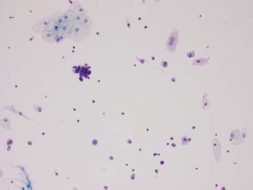 Urine cytology | Basicmedical Key