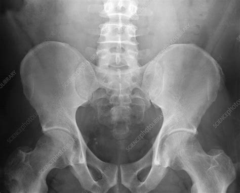 Pelvic X-ray - Stock Image - P116/0713 - Science Photo Library