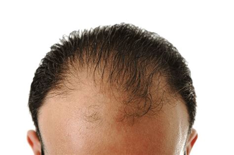 Hair Loss In Men | TrichoStem Hair Regeneration Centers