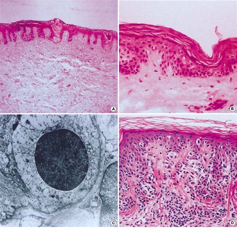 Figure 2 from Development of multiple pigmented nevi within segmental nevus depigmentosus ...