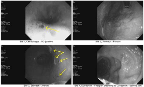 Recent endoscopy diagnosed gastritis, but no explanation of images and ...