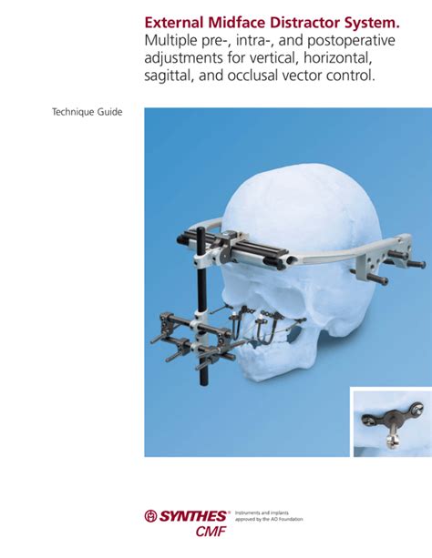 External Midface Distractor System Technique Guide