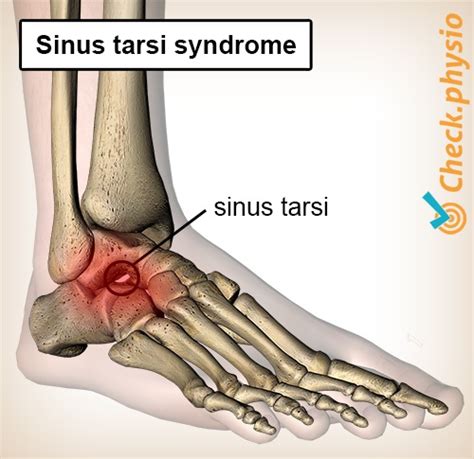 Sinus tarsi syndrome | Physio Check