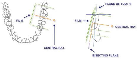 Dentistry and Medicine: Intraoral Radiographic Techniques (The Bisecting Angle Technique)-Chapter 3