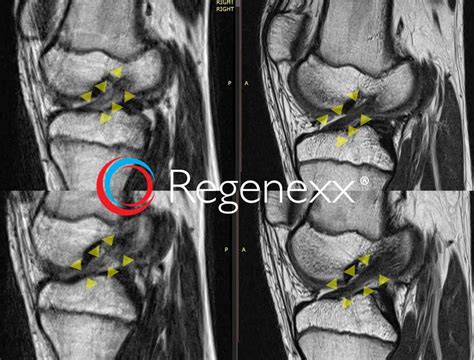 acl knee surgery side effects