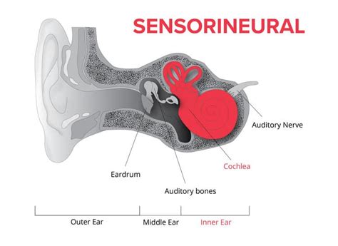 Types of Hearing Loss & Degrees of Hearing Loss | Speech & Hearing ...