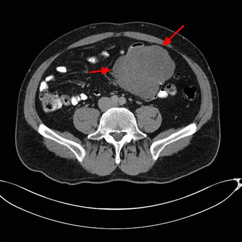 Desmoid Tumor - Causes, Symptoms, Survival Rate, Treatment