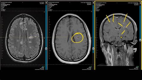 Ms Brain Mri With Contrast