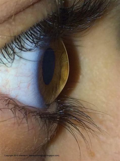 Photos of the Cornea in a Patient with Keratoconus | Keratoconus Group