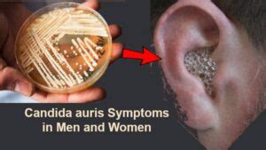 Candida auris Symptoms in Men and Women should never be ignored!