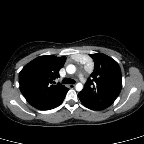 Castleman Disease - Causes, Symptoms, Diagnosis, Treatment