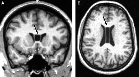 Septum Pellucidum Mri