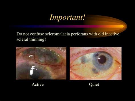 PPT - Scleritis Diagnosis & Management PowerPoint Presentation - ID:5542222