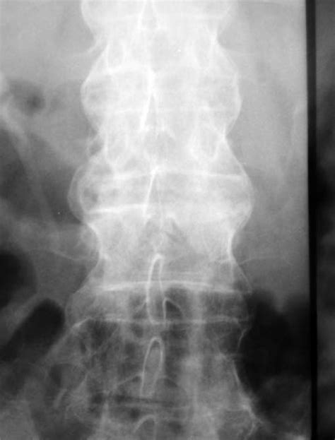 -Classical Radiological Aspect Showing the "Bamboo" Spine in Ankylosing... | Download Scientific ...