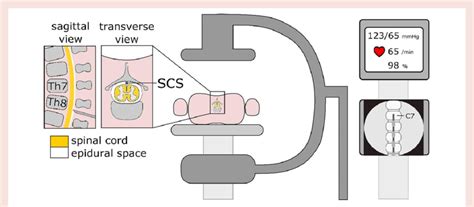 Schematic overview of set-up spinal cord stimulator implantation ...